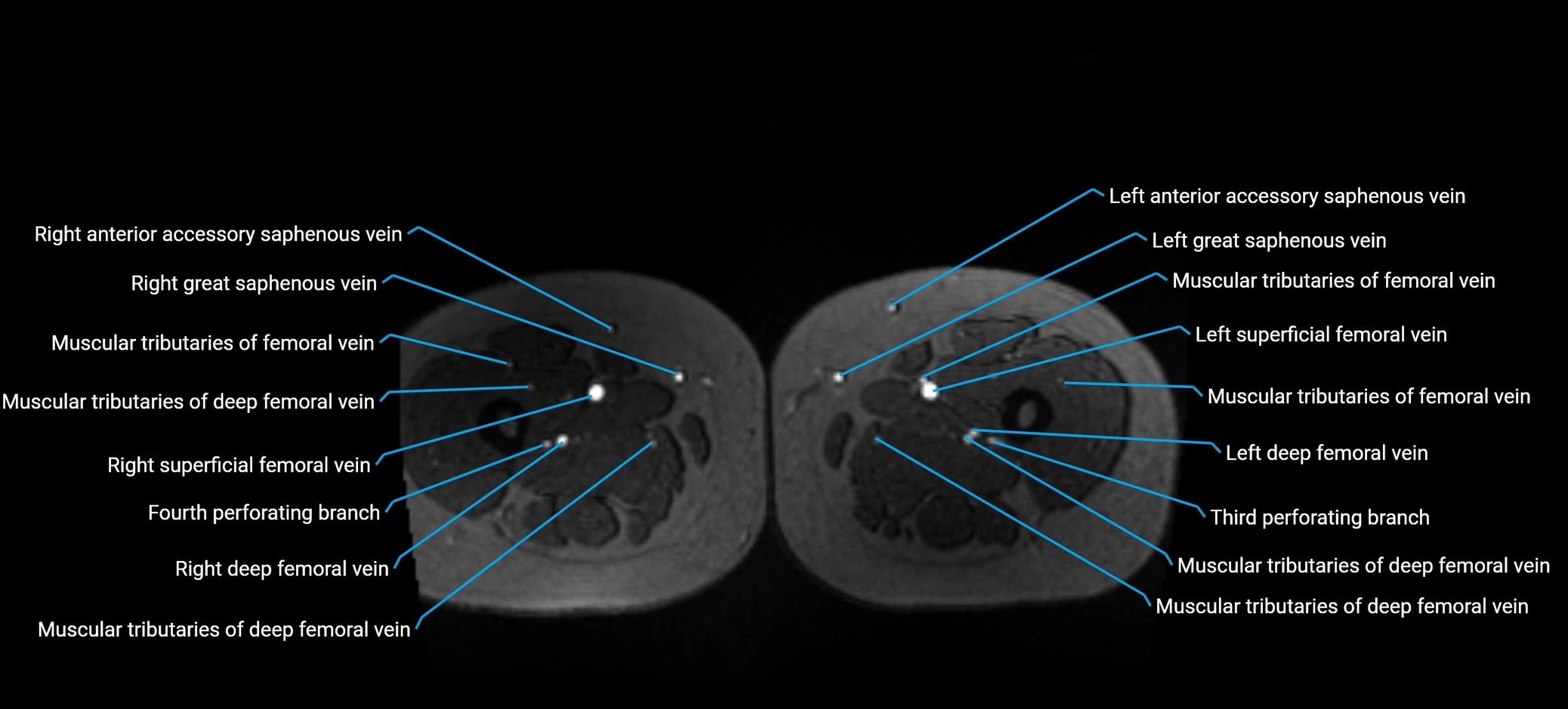 MRV abdomen pelvis & lower limb axial cross sectional anatomy labelled MRI image 250 (1).webp